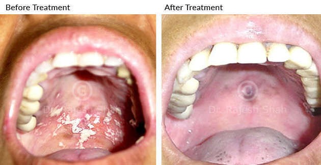 oral_lichen_planus_before_after_4